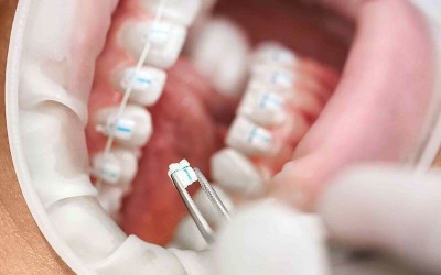 Bung Mắc Cài Phải Làm Sao? Cách Xử Lý An Toàn Tại Nhà