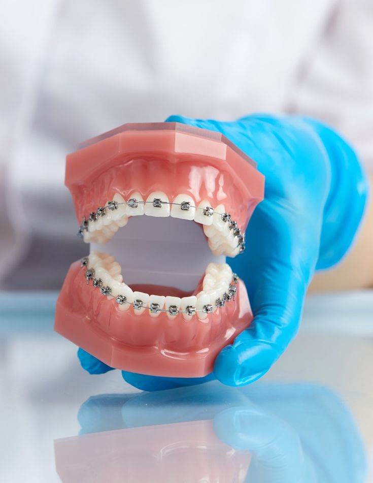 Niềng răng có được vĩnh viễn không? Mẹo giữ răng đều đẹp trọn đời