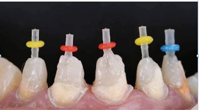 Cắm Chốt Răng – Giải Pháp Giữ Lại Răng Gãy, Vỡ Tưởng Phải Nhổ Bỏ