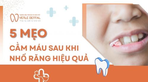 Bật mí 5 mẹo cầm máu sau khi nhổ răng hiệu quả, an toàn
