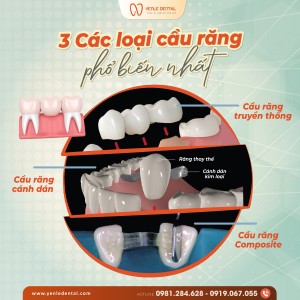 3 LOẠI CẦU RĂNG PHỔ BIẾN NHẤT – GIẢI PHÁP PHỤC HÌNH RĂNG NHANH ĐÓN TẾT