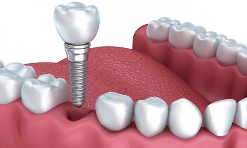 GIÁ CẤY IMPLANT – CHI PHÍ CHUẨN & NHỮNG ĐIỀU CẦN BIẾT TRƯỚC KHI QUYẾT ĐỊNH