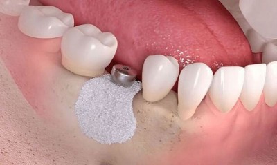 Thời gian hồi phục sau tái tạo xương ổ răng – Mất bao lâu để xương tích hợp?