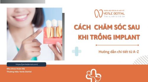 Hướng dẫn chăm sóc sau khi trồng răng Implant từ A-Z