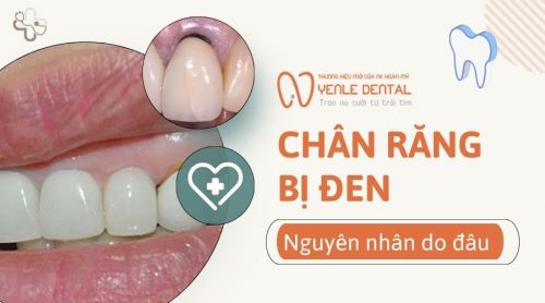 Chân răng bị đen là do đâu? 5 Nguyên nhân thường gặp