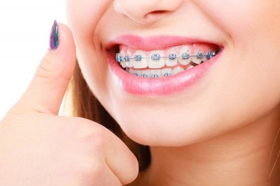 40 tuổi có niềng răng được không? Giải đáp từ chuyên gia chỉnh nha