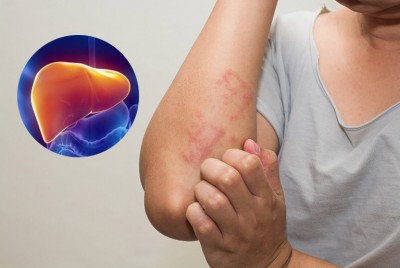 MỀ ĐAY, MẨN NGỨA THƯỜNG LÀ DO GAN “QUÁ TẢI” – ÁP DỤNG NGAY 2 CÁCH THẢI ĐỘC CƠ THỂ