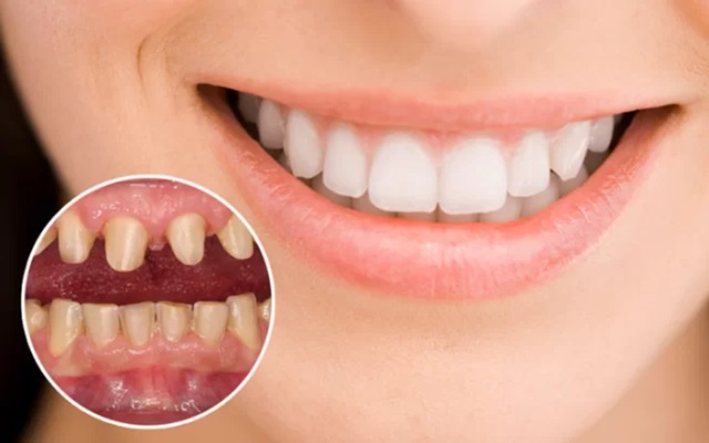 Có nên bọc sứ cercon không?