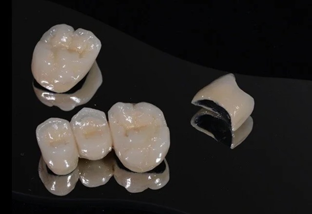 Có nên chọn sứ kim loại không?