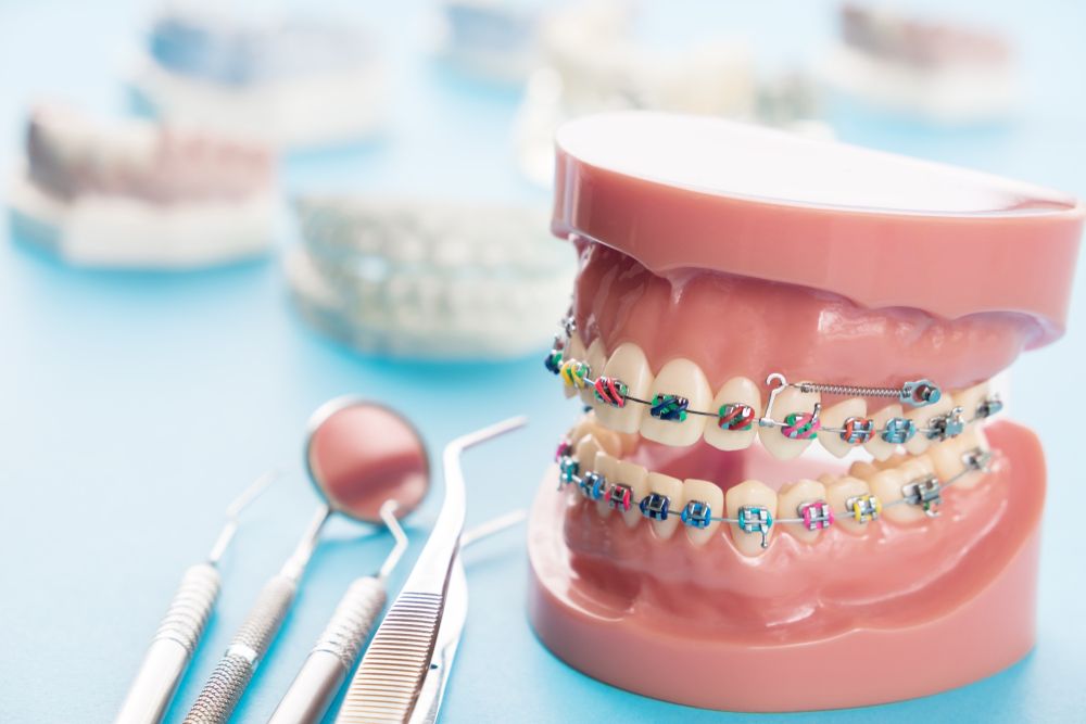 ưu điểm niềng răng mắc cài kim loại