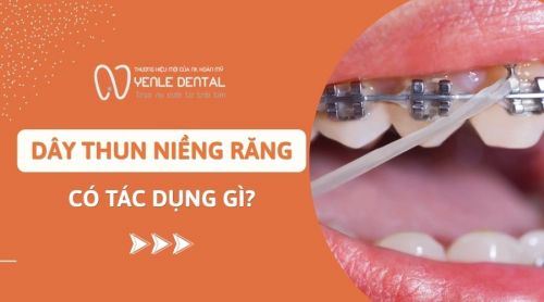 Dây thun niềng răng có tác dụng gì? Những lưu ý khi sử dụng