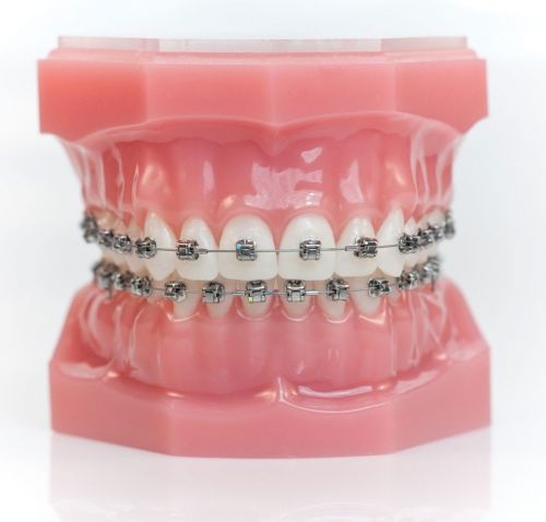 Niềng răng bao nhiêu tiền? Chi Phí Niềng Răng Cập Nhật Mới Nhất 2026