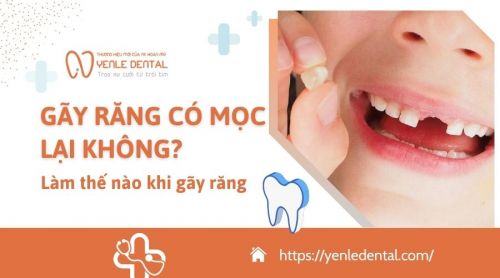 Gãy răng có mọc lại không? Phải làm gì khi bị gãy răng?