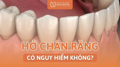 Hở chân răng có nguy hiểm không? Nguyên nhân và cách điều trị