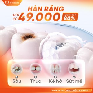 Tại Sao Phải Hàn Răng Sâu? (Ưu Đãi Hàn Răng Chỉ Từ 49K)
