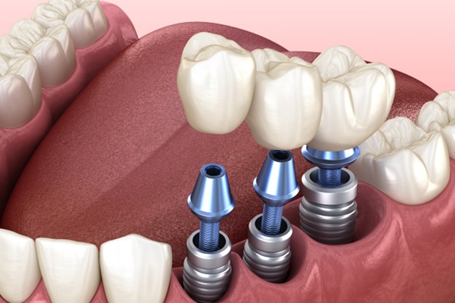 Implant một phần