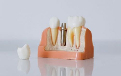 So sánh Trồng răng Implant và Làm cầu răng sứ: Đâu là lựa chọn tối ưu nhất?