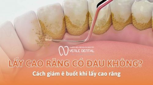 Lấy cao răng có đau không? Cách giảm ê buốt khi lấy cao răng
