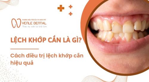 Lệch khớp cắn là gì? Cách điều trị lệch khớp cắn hiệu quả