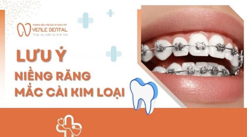 10+ Lưu ý khi niềng răng mắc cài kim loại không thể bỏ qua