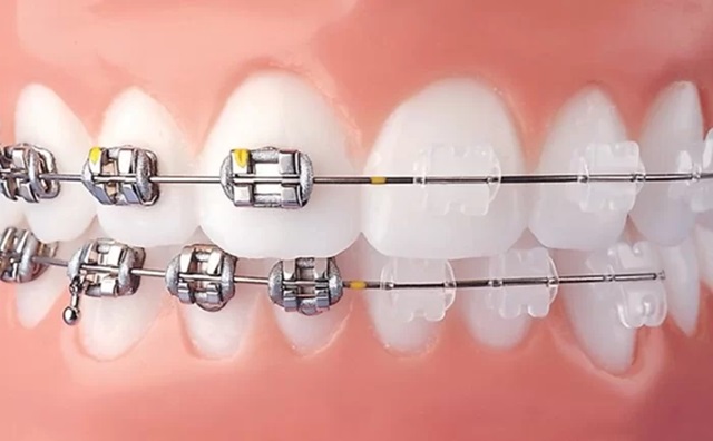 Mắc cài kim loại và mắc cài trong suốt