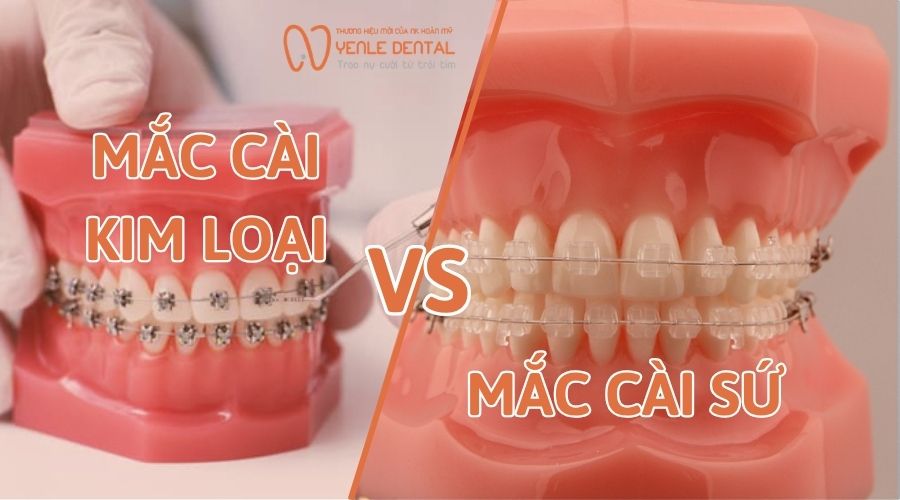 mắc cài kim loại vs mắc cài sứ