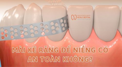 Mài kẽ răng để niềng có an toàn không? Những lưu ý khi mài kẽ răng