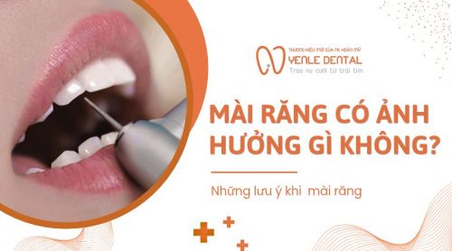 Mài răng có ảnh hưởng gì không? Những điều cần lưu ý