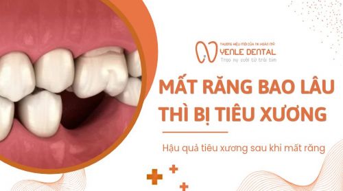 Giải đáp: Mất răng bao lâu thì bị tiêu xương hàm?