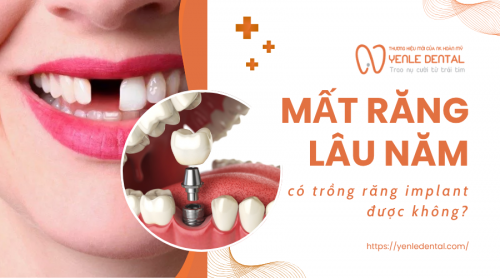 Mất răng lâu năm có trồng răng implant được không?