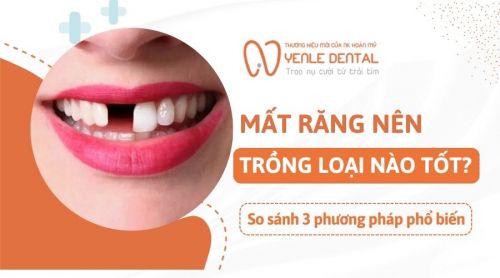 Mất răng nên trồng loại nào tốt? So sánh 3 phương pháp phổ biến