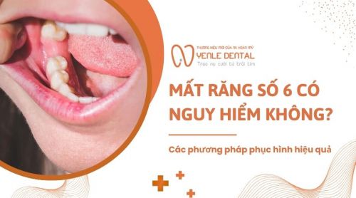 Mất răng số 6 có nguy hiểm không? Các phương pháp phục hình hiệu quả