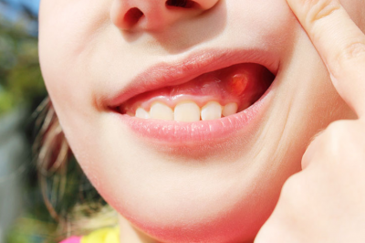 Nang chân răng sữa – Đừng xem nhẹ! Nhận biết sớm để tránh biến chứng cho răng vĩnh viễn