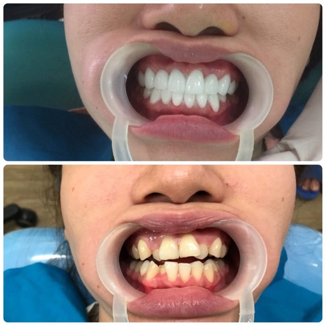 Người cần cải thiện hình dáng răng