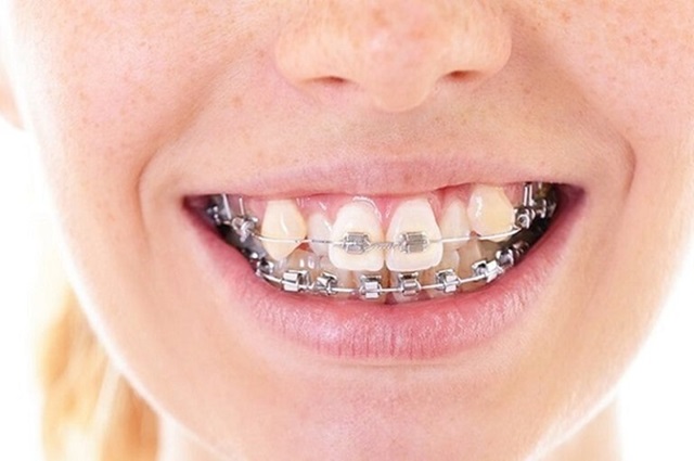 Người có răng khểnh nên niềng răng