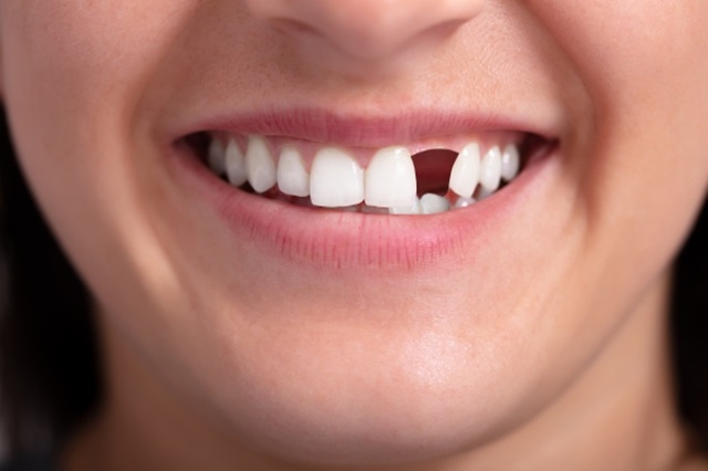 Người mất răng nên cắm implant