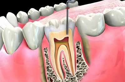 CHẤN THƯƠNG RĂNG DO TAI NẠN – CÓ GÂY VIÊM TỦY KHÔNG?