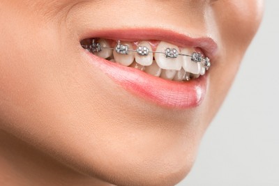 Những ưu điểm vượt trội của niềng răng mắc cài