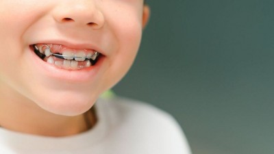 Niềng Răng Cho Trẻ Em Có Nên Hay Không? Những Lưu Ý Cha Mẹ Cần Biết