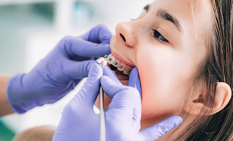 nieng-rang-cho-tre-em-co-nen-hay-khong