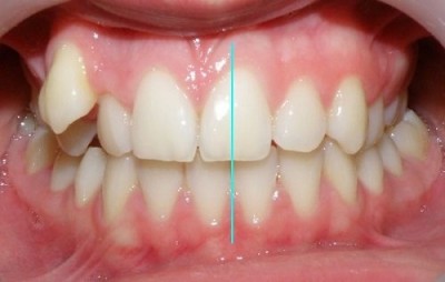 Dấu hiệu nhận biết niềng răng hỏng và địa chỉ 