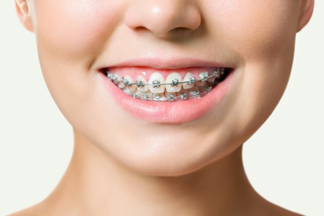 Niềng răng mắc cài là gì?