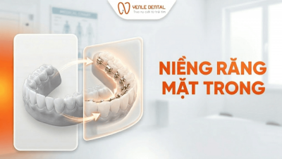 Niềng Răng Mặt Trong Có Tốt Không? Những Lưu Ý Khi Lựa Chọn