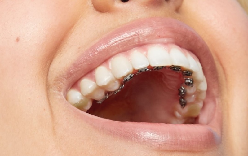 Ưu nhược điểm của phương pháp niềng răng mặt trong