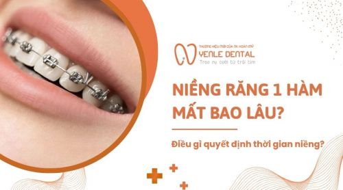 Niềng răng 1 hàm mất bao lâu? Điều gì quyết định thời gian niềng?
