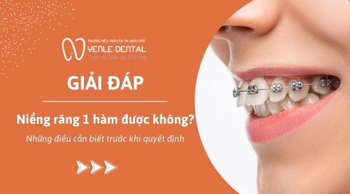 Niềng răng 1 hàm được không? Những điều cần biết trước khi quyết định