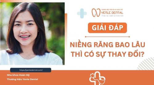 Bác sĩ giải đáp: Niềng răng bao lâu thì có sự thay đổi?