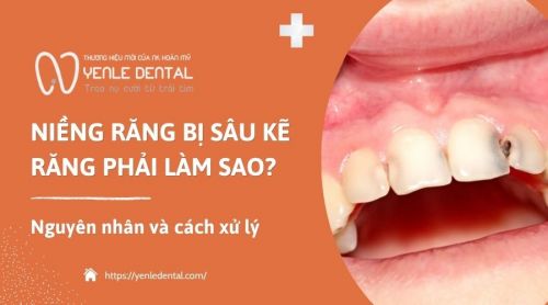 Niềng răng bị sâu kẽ răng phải làm sao? Nguyên nhân và cách xử lý