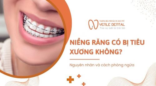 Niềng răng có bị tiêu xương không? Nguyên nhân và cách phòng ngừa
