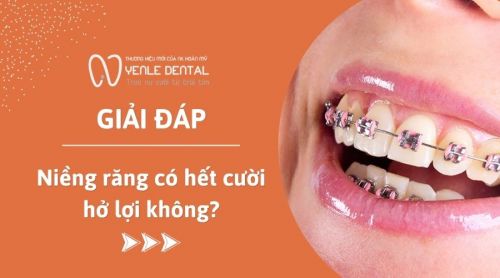 Bác sĩ giải đáp: Niềng răng có hết cười hở lợi không?